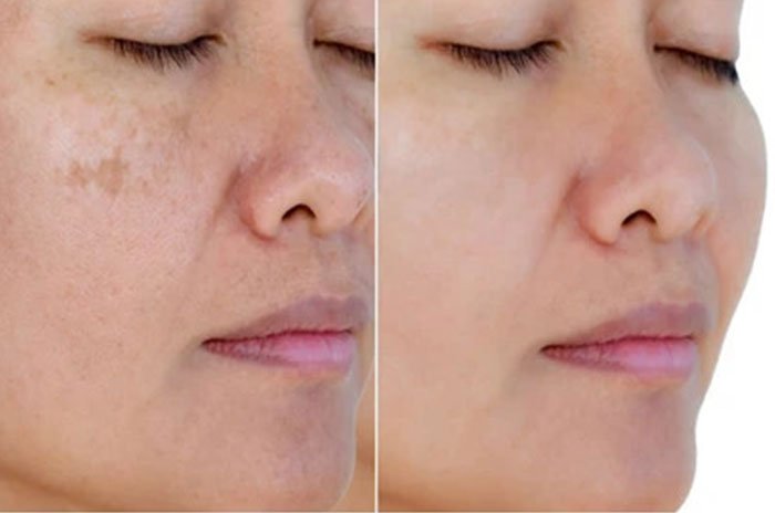 Anti Aging & Melasma Treatment