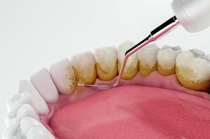 Teeth Cleaning and Whitening Treatment